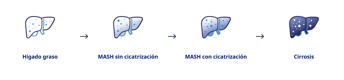 Ícono del hígado graso, Ícono del hígado con MASH sin cicatrización, Ícono del hígado con MASH con cicatrización, Ícono del hígado con cirrosis